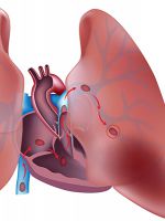 Тромбоэмболия легочной артерии – симптомы, лечение 