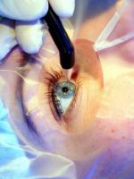 Операция по коррекции зрения