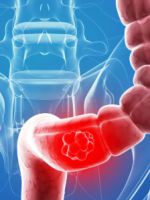 Онкология кишечника – симптомы и признаки болезни