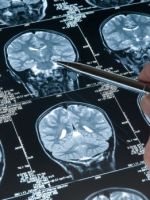 Опухоль головного мозга – все, что нужно знать о заболевании