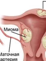Миома матки – симптомы и лечение болезни на разных стадиях