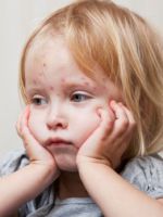 Краснуха – симптомы у детей, о которых нужно знать всем родителям