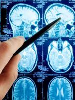 Отек мозга – экстренные меры и правильное лечение