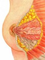 Внутрипротоковая папиллома молочной железы – как предупредить рак?