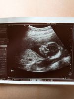 Первый скрининг при беременности – когда и как проводят обследование?