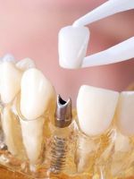 Коронка на зуб – как выбирают и ставят несъемный протез?
