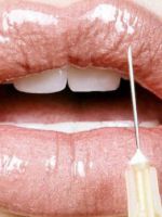 Увеличение губ гиалуроновой кислотой – стоит ли решаться на процедуру?