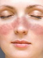 Экзема на лице – причины  и лечение всех видов болезни