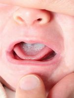 Белый налет на языке у ребенка – безобидные причины и опасные признаки