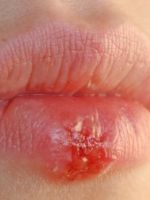 Герпес на губах – причины и быстрое лечение 