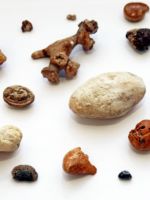 Камень в мочеточнике – симптомы, причины и лечение у женщин