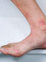 Дерматит на ногах – причины и лечение всех видов недуга