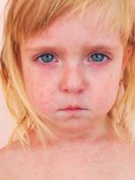 Розеола у детей – симптомы, о которых важно знать родителям
