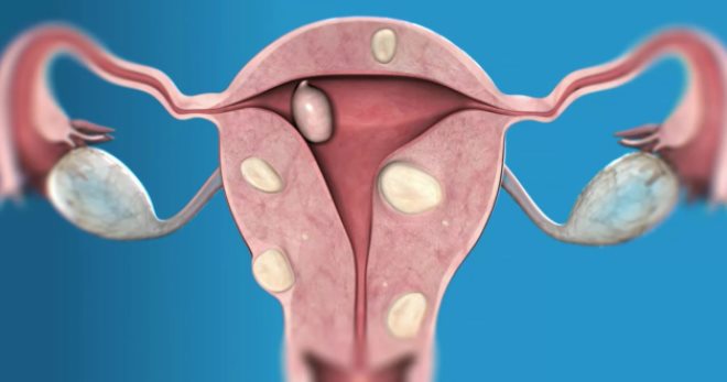 Рак эндометрия – причины и симптомы всех форм опухоли