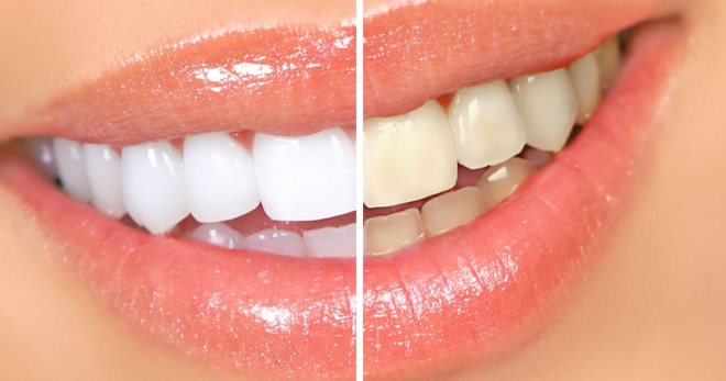Отбеливание зубов – как отбелить зубы в домашних условиях или в стоматологии?