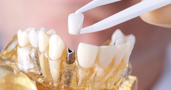 Коронка на зуб – как выбирают и ставят несъемный протез?