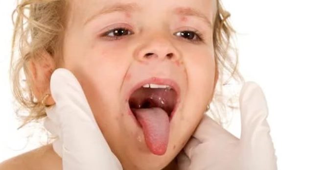 Герпес в горле у ребенка – как распознать и лечить герпесную ангину у детей?