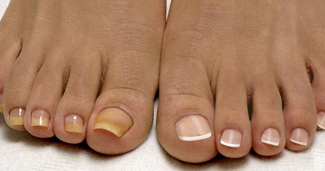 Грибок на ногах – самые эффективные средства лечения кожной и ногтевой форм
