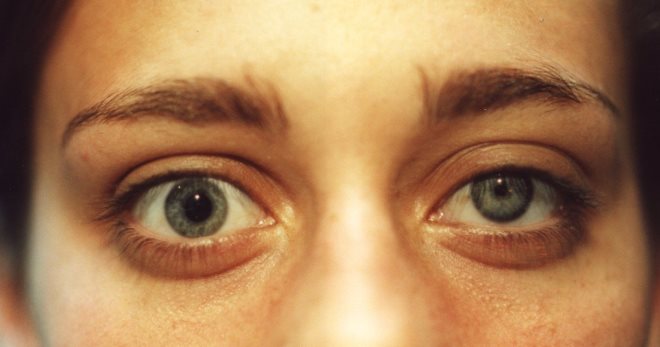 Синдром Горнера – как можно нормализовать зрение?