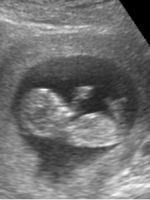 12 неделя беременности - пол ребенка на УЗИ