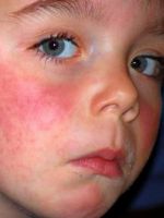 Аллергия у ребенка - как лечить?