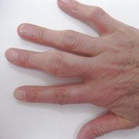 наросты на суставах пальцев рук