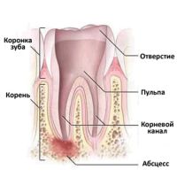 Абсцесс зуба симптомы