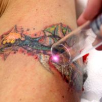 удалить татуировку лазером