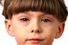 чем промывать глаза при конъюнктивите у детей