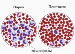 Анализ крови эозинофилы понижены