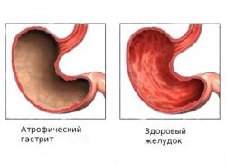 Атрофия слизистой оболочки желудка