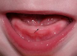 Как режутся первые зубы симптомы