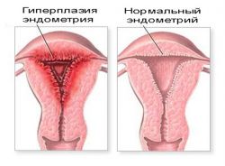 гиперплазия эндометрия и беременность