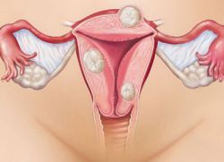 фиброматоз  тела матки