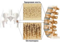 первые признаки остеопороза