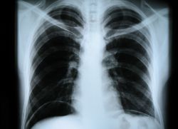 Рентгенография грудной клетки