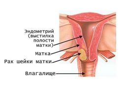 рак шейки матки признаки