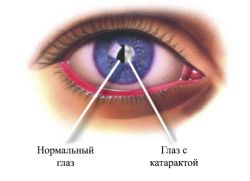 Симптомы катаракты глаза