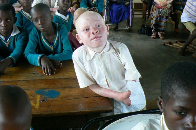 альбиносы в Танзании