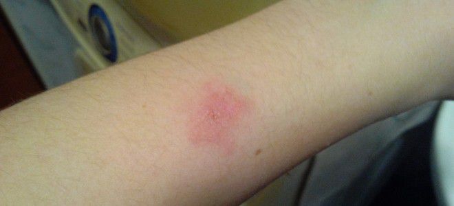Аллергия на укусы комаров симптомы раз
