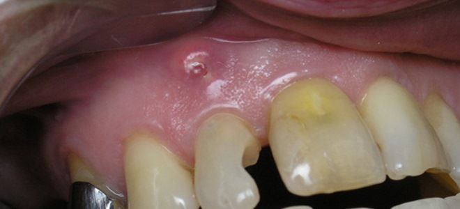 гранулема на корне зуба