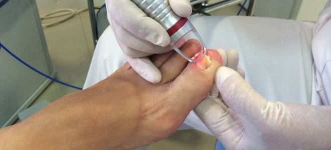 удаление гранулемы ногтя
