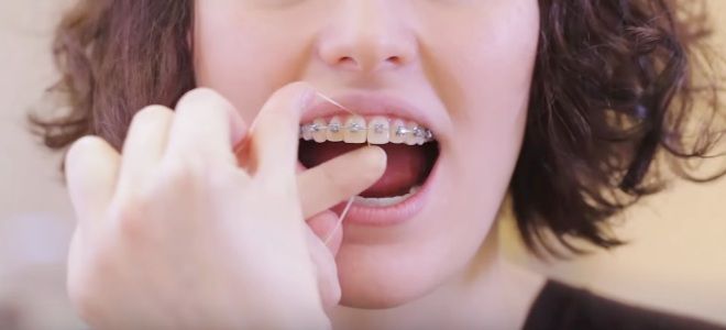 Как чистить зубы ершиком для брекетов третий