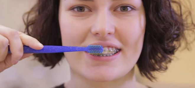 Как чистить зубы с брекетами зубной щеткой первый