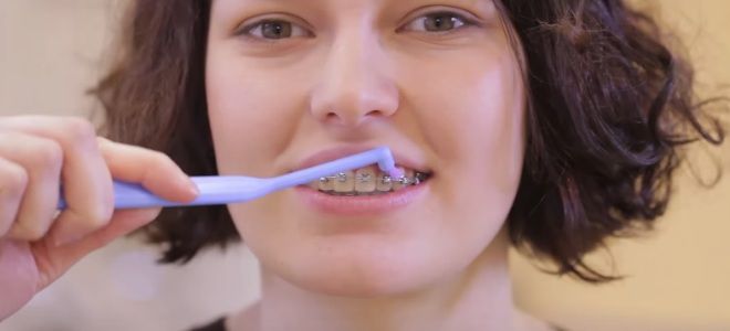 Как чистить зубы с брекетами зубной щеткой пятый