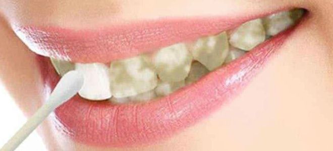 аптечные средства для отбеливания зубов