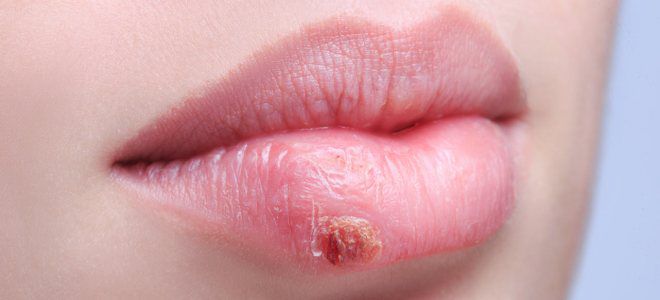 Герпес на лице симптомы губы