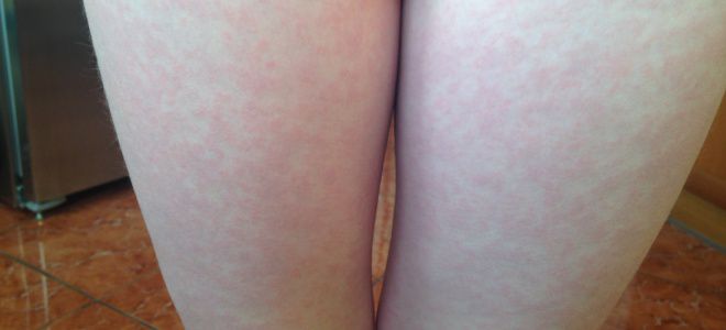 Холодовая аллергия на ногах