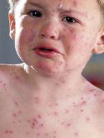 Аллергия на сладкое у ребенка