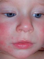 Атопический дерматит у детей - лечение